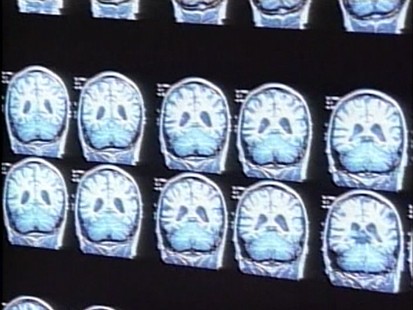 Adults who scored high on the test were more likely to develop the disease.