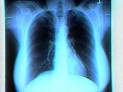 x-ray