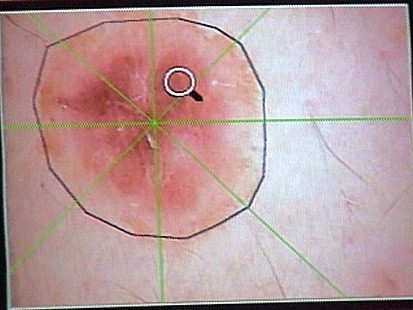 Melanoma