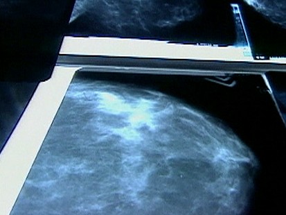 VIDEO: Bone Drugs May Fight Breast Cancer