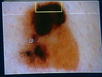 VIDEO: Skin Cancer Cases Rising Among Latinos