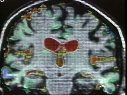 VIDEO: An image of a brain