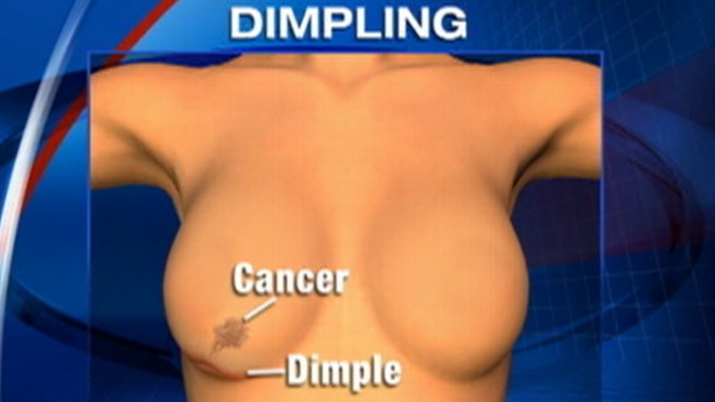 Dimpling skin could be a sign of breast cancer Video - ABC News