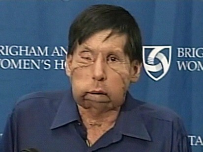 VIDEO: James maki receives a partial face transplant.
