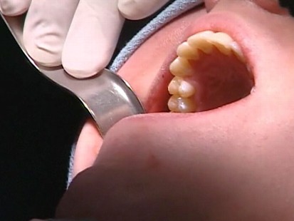 Video: Using teeth for their stem cells.