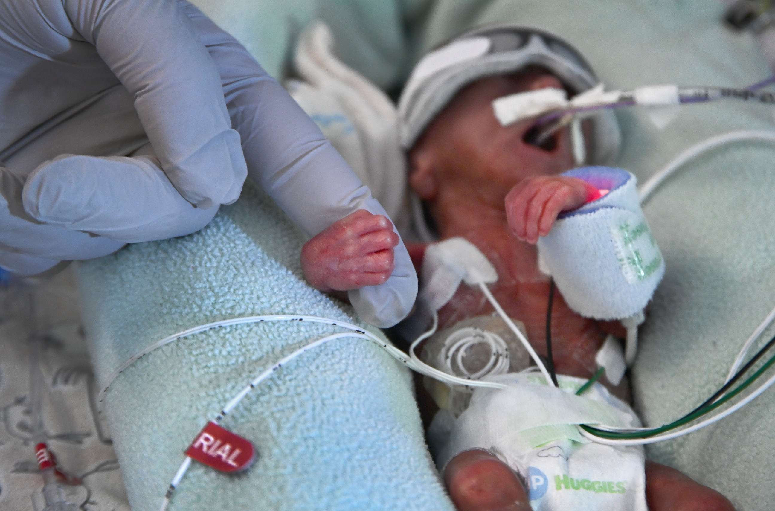 PHOTO: A 2 day old premature baby is cared for in the neonatal intensive care unit of a hospital in Iowa City, Iowa, Aug. 11, 2021.
