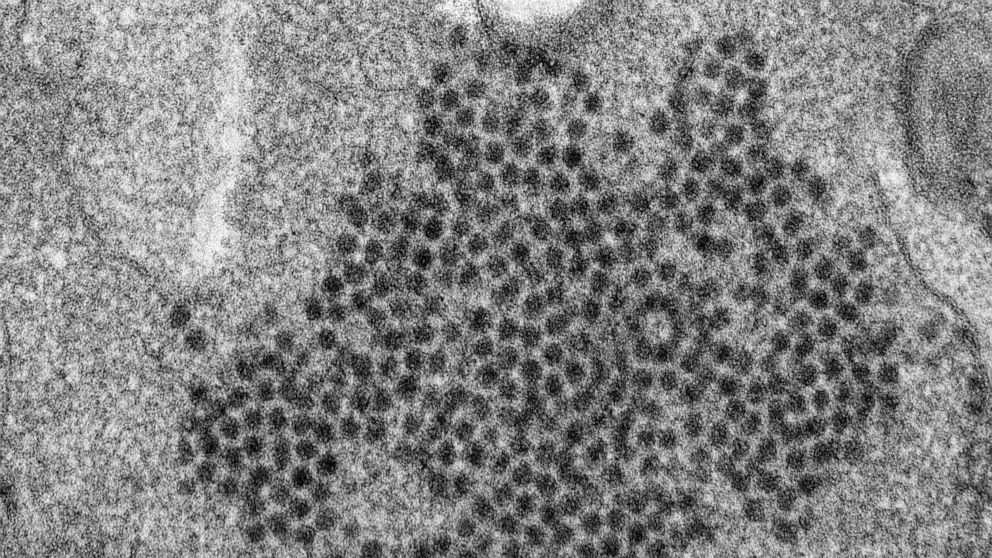PHOTO: This 2014 file electron microscope image made available by the Centers for Disease Control and Prevention shows numerous, spheroid-shaped enterovirus-D68 (EV-D68) virions.