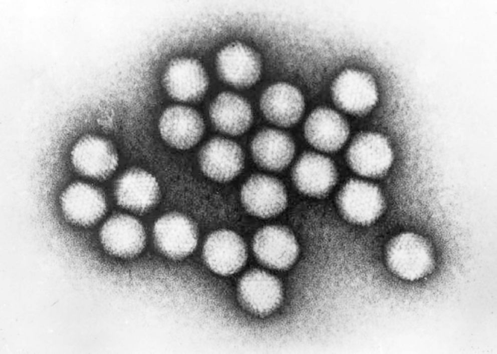 PHOTO: This 1981 electron microscope image made available by the Centers for Disease Control and Prevention shows a group of adenovirus virions.