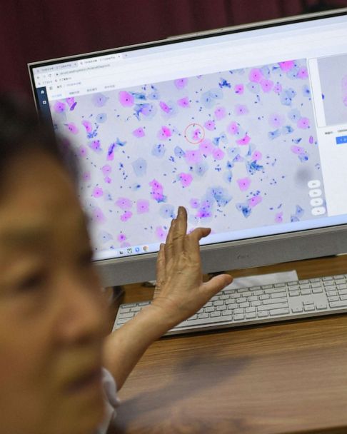 Promising new AI can detect early signs of lung cancer that doctors can't  see