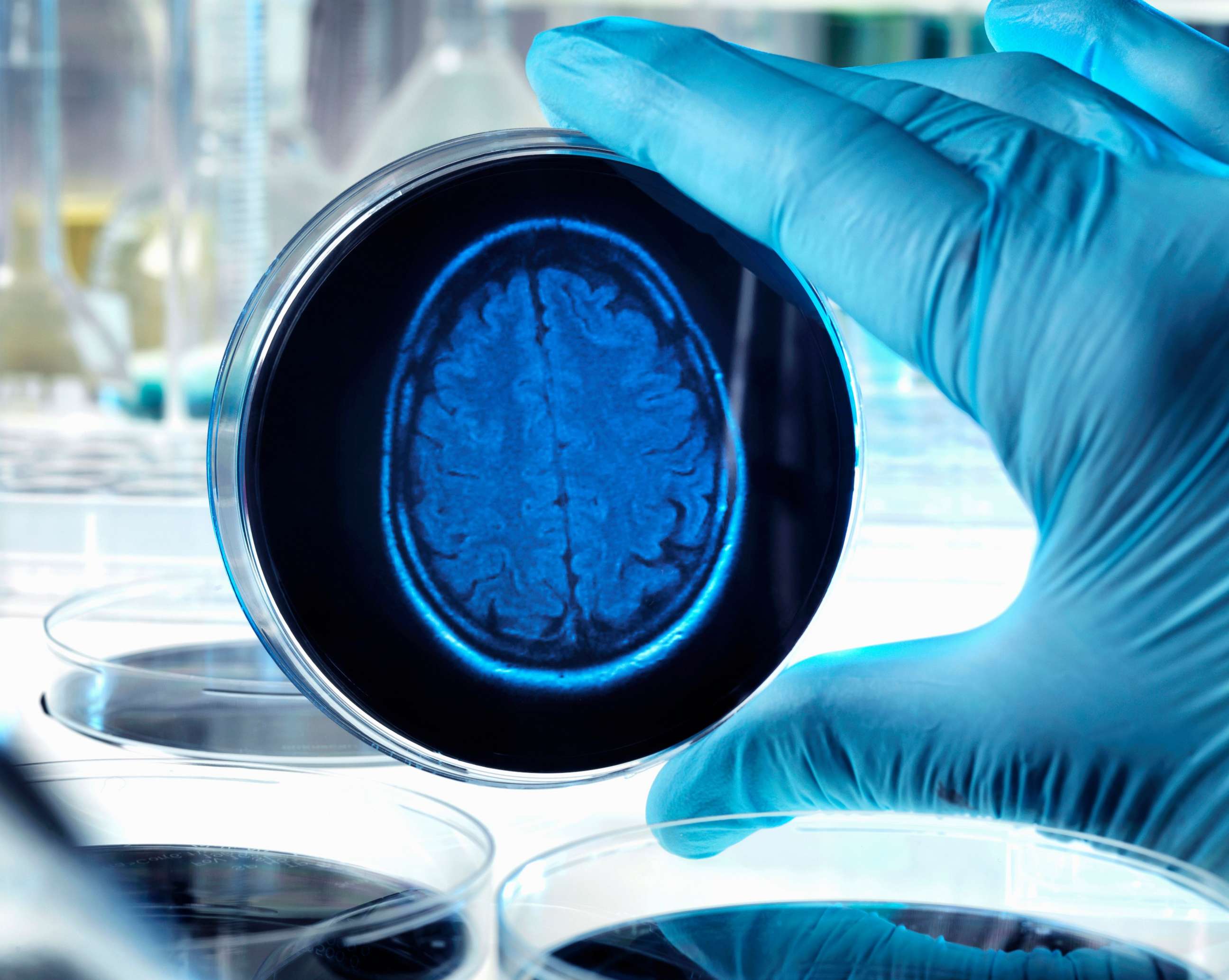 PHOTO: A stock image depicts a brain scan in a dish.