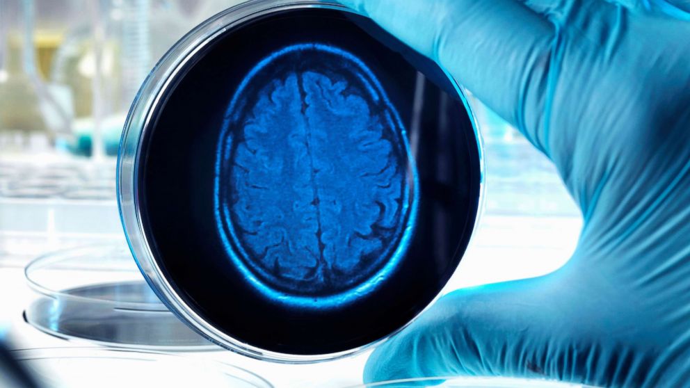 PHOTO: A stock image depicts a brain scan in a dish.