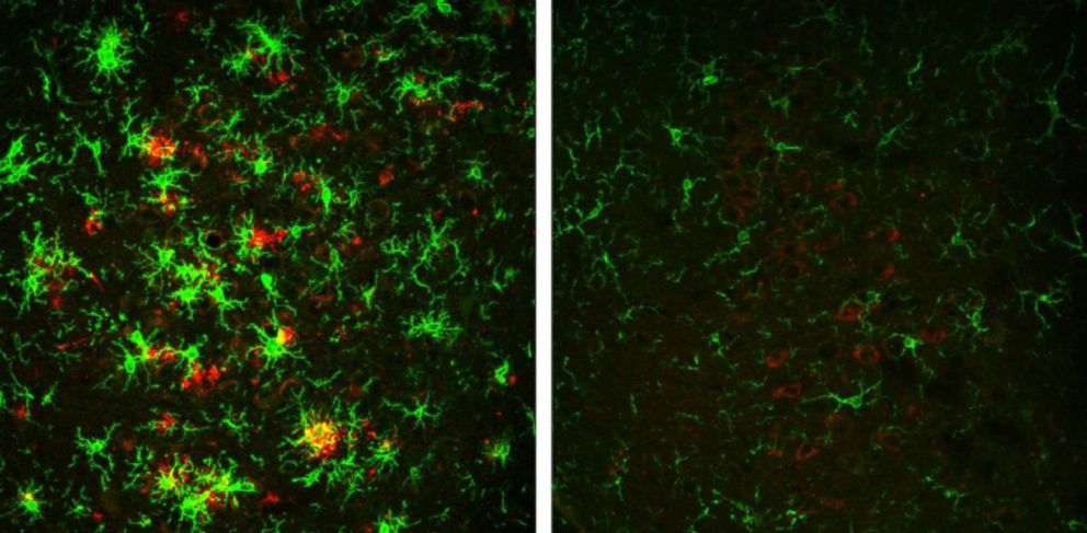 PHOTO: At left, the brain of a mouse with Alzheimer's disease full of amyloid plaques shown in red,  surrounded by activated microglial cells, in green. These indicators are reversed in animals that have gradually lost the BACE1 enzyme, shown at right.