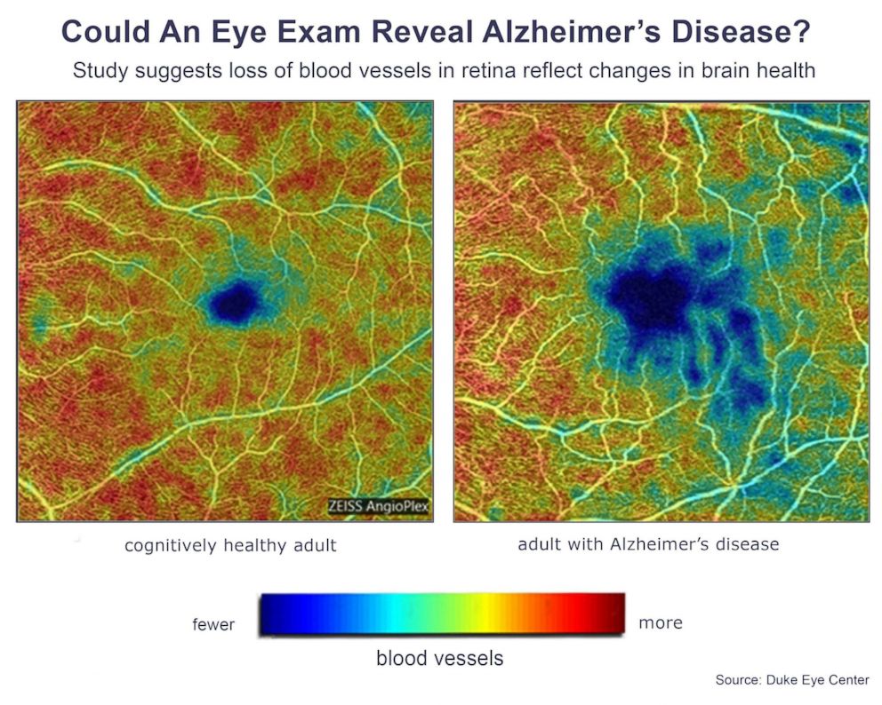 PHOTO: On the left, a photo of the retina of a cognitively health. On the right, a photo of the retina of an adult with Alzheimer’s disease.