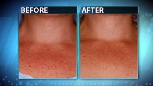 Skin Treatments For The Chest Video Abc News