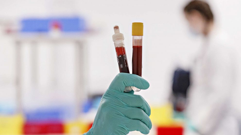 PHOTO: An employee shows a blood sample for COVID-19 antibody testing at home at the Labor Dr. Heidrich & Kollegen MVZ GmbH medical lab, on April 16, 2020, in Hamburg, Germany. 