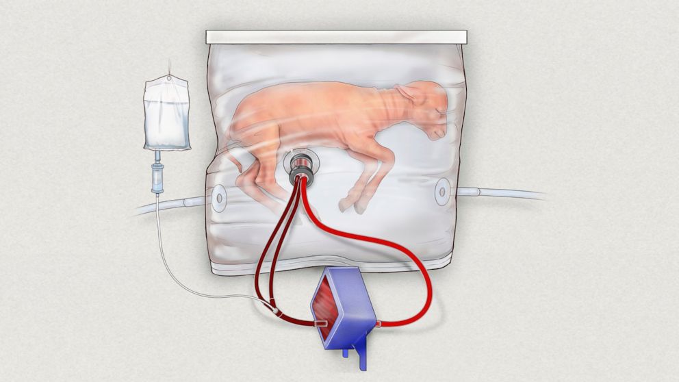PHOTO: In this drawing provided by the Children's Hospital of Philadelphia, an illustration of a fluid-filled incubation system that mimics a mother's womb, in hopes of one day improving survival of extremely premature babies.