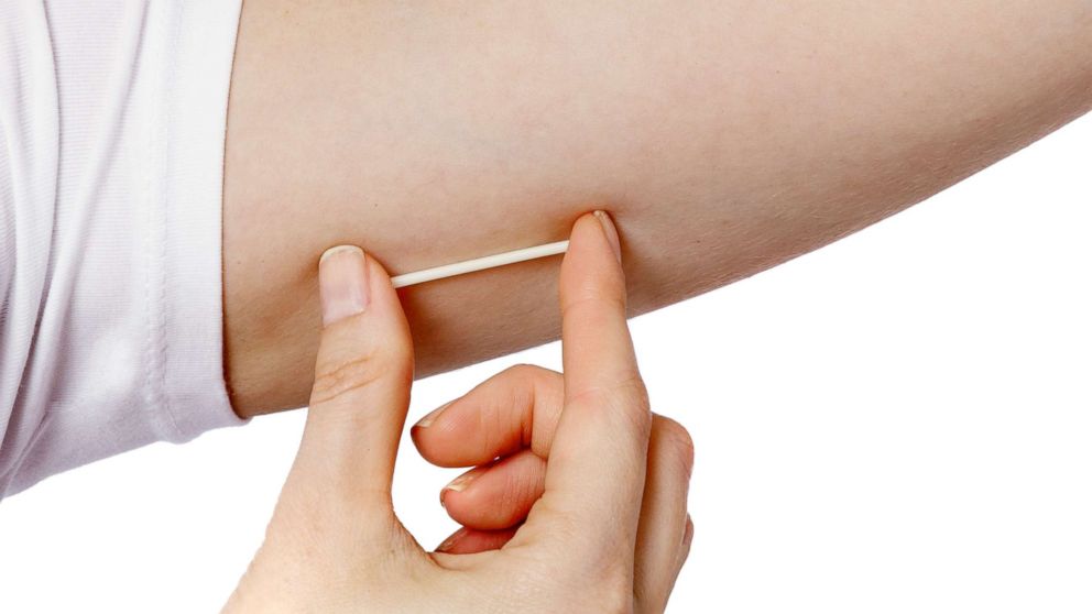 FILE - In this undated image provided by Merck, a model holds a Nexplanon birth control hormonal implant. 