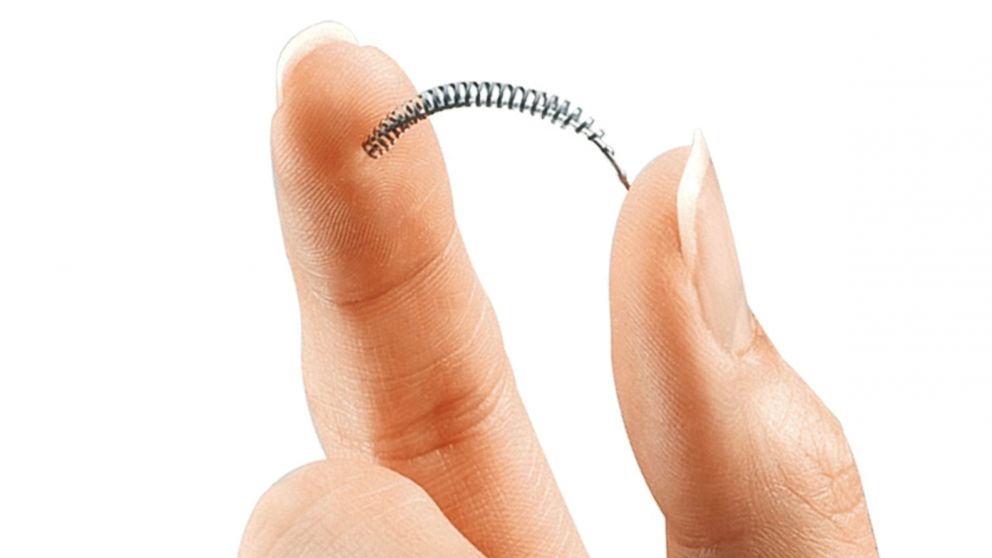 PHOTO: This image provided by Bayer Healthcare Pharmaceuticals shows the birth control implant Essure.