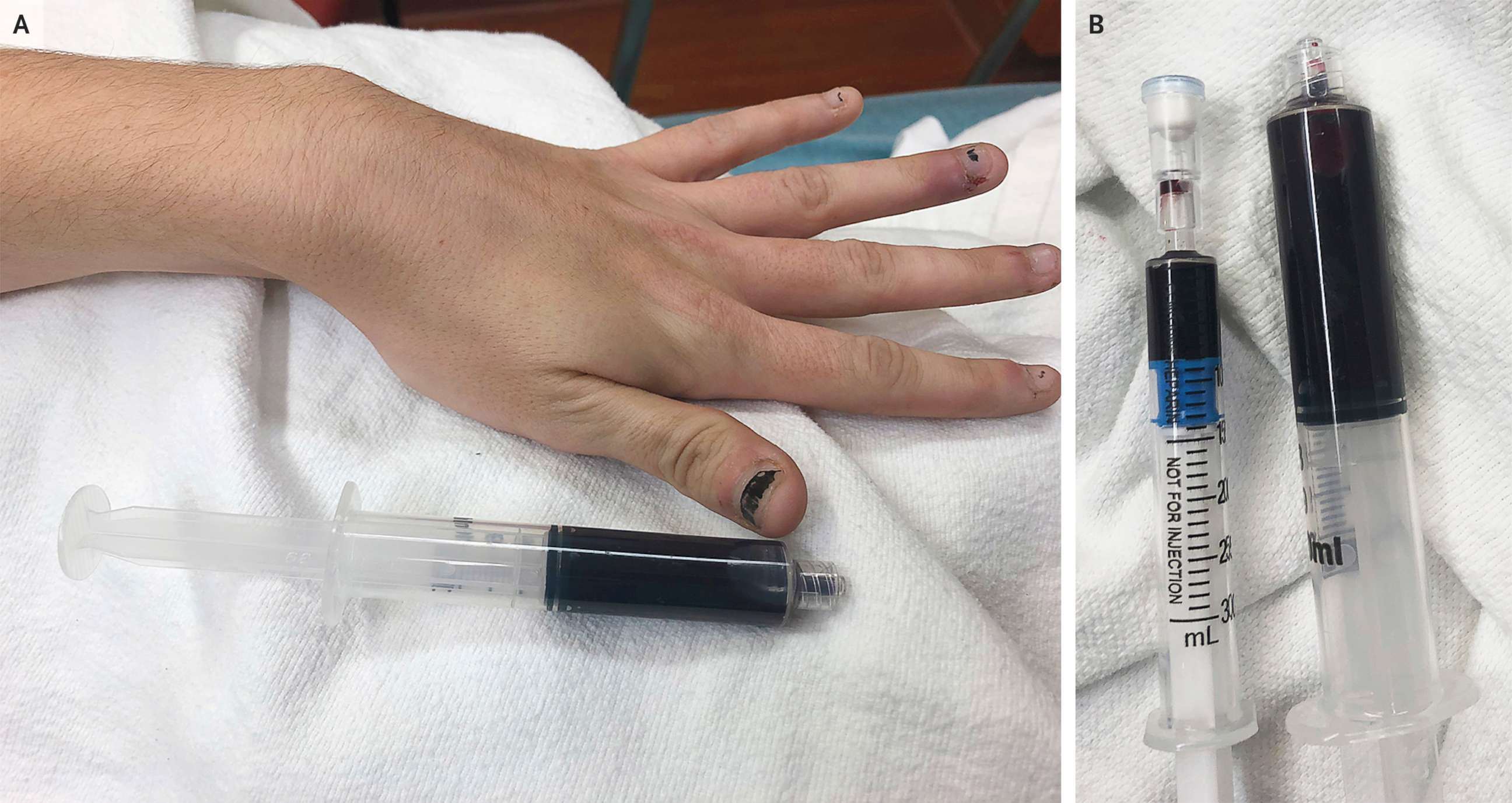 PHOTO: A 25-year-old Rhode Island woman's blood turned navy blue after taking large amounts of an over-the-counter medication containing benzocaine.