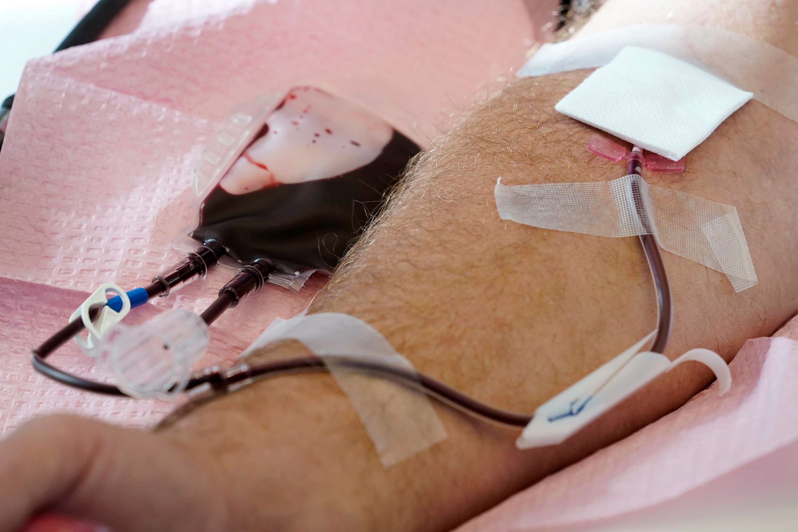 PHOTO: Tubes direct blood from a donor into a bag in Davenport, Iowa, Nov. 11, 2022.