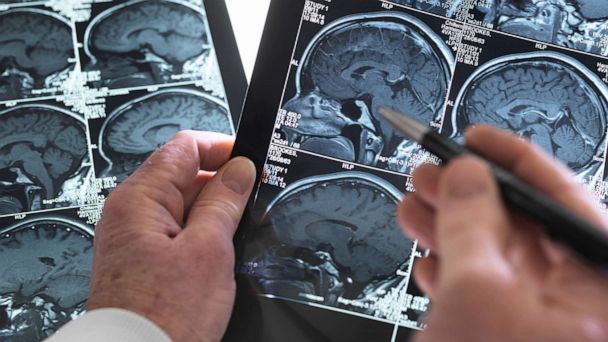Lifelong Antisocial Behavior Linked To Abnormal Brain Structure Study Abc News