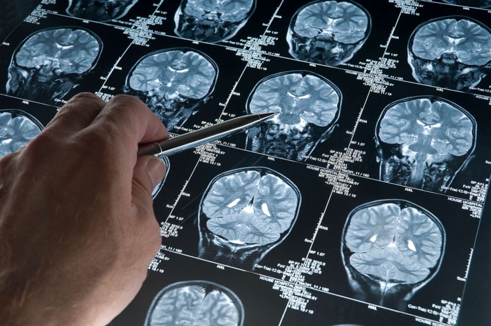 PHOTO: An undated stock photo depicts a brain scan.