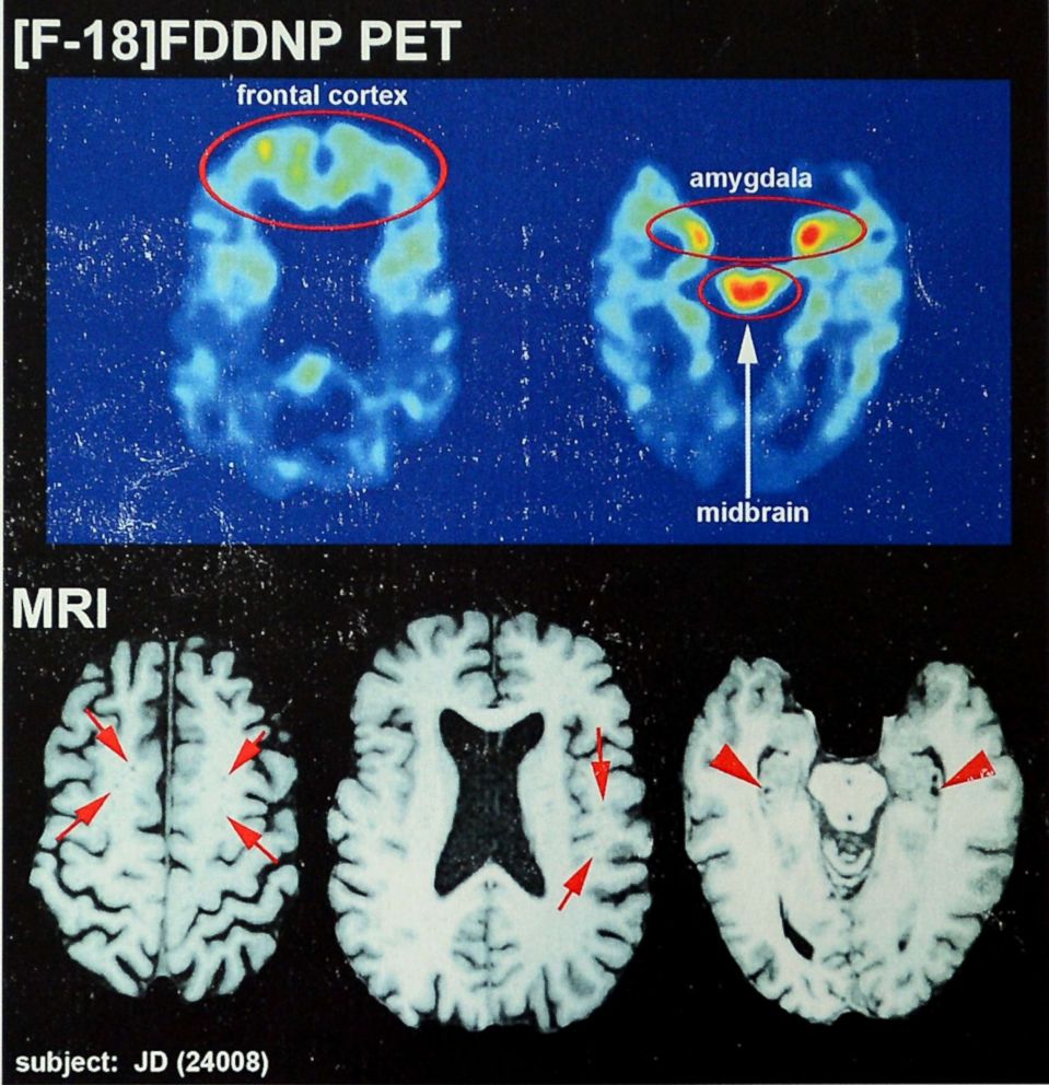 PHOTO: A photo made on Jan. 21, 2014 shows brain scans of an NFL player who was diagnosed with CTE.
