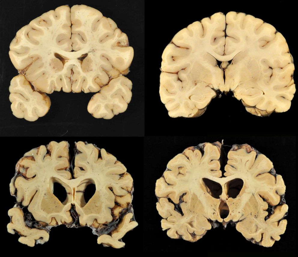 Former NFL player confirmed as 1st diagnosis of CTE in ...