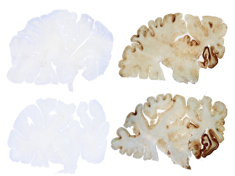 PHOTO: A control brain, left, contrasted with a brain that has CTE, right.