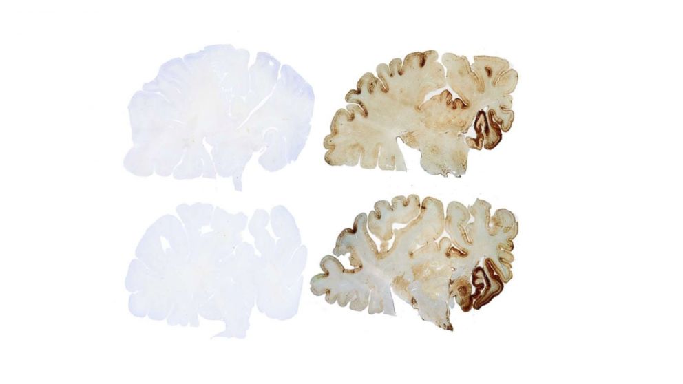 PHOTO: A control brain, left, contrasted with a brain that has CTE, right.