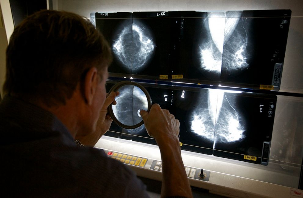 PHOTO: In this May 6, 2010 file photo, a radiologist checks mammograms in Los Angeles.
