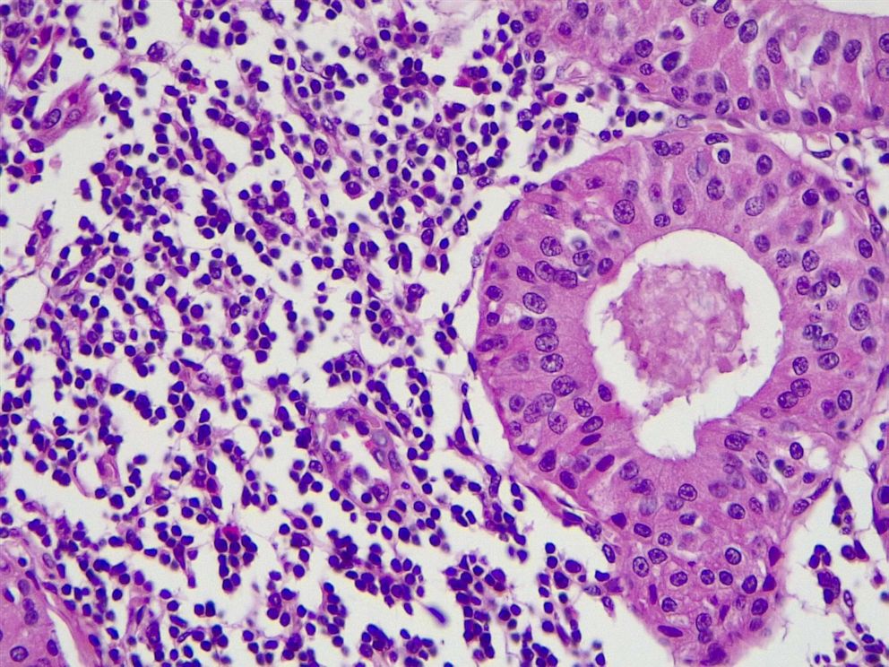 PHOTO: Light micrograph of adenolymphoma cancer cell.