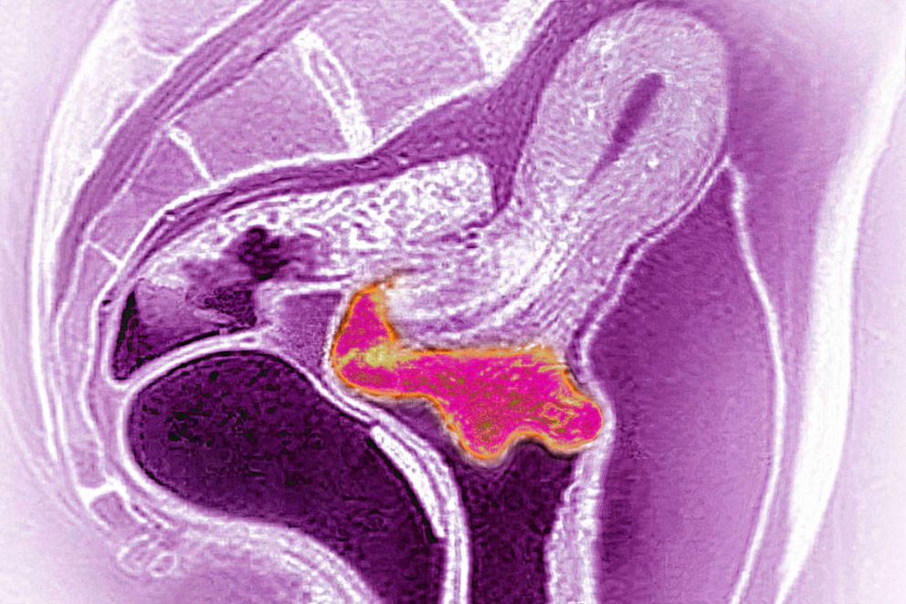 Foto: RMN sagital reprezentând cancer de col uterin, 8 octombrie 2021.