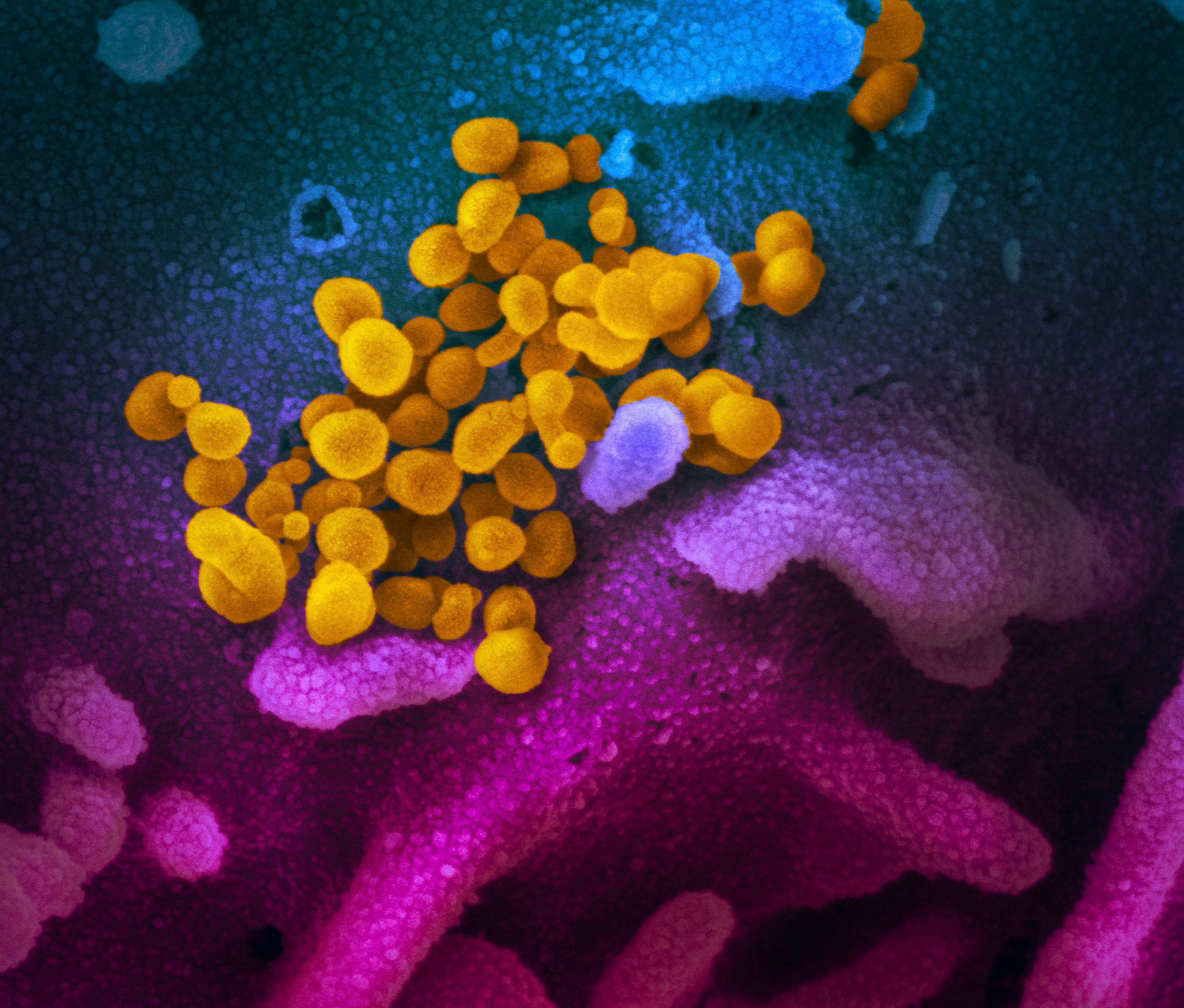 PHOTO: This handout illustration image taken with a scanning electron microscope shows SARS-CoV-2 (yellow)also known as 2019-nCoV, the virus that causes COVID-19isolated emerging from the surface of cells (blue/pink) cultured in the lab.