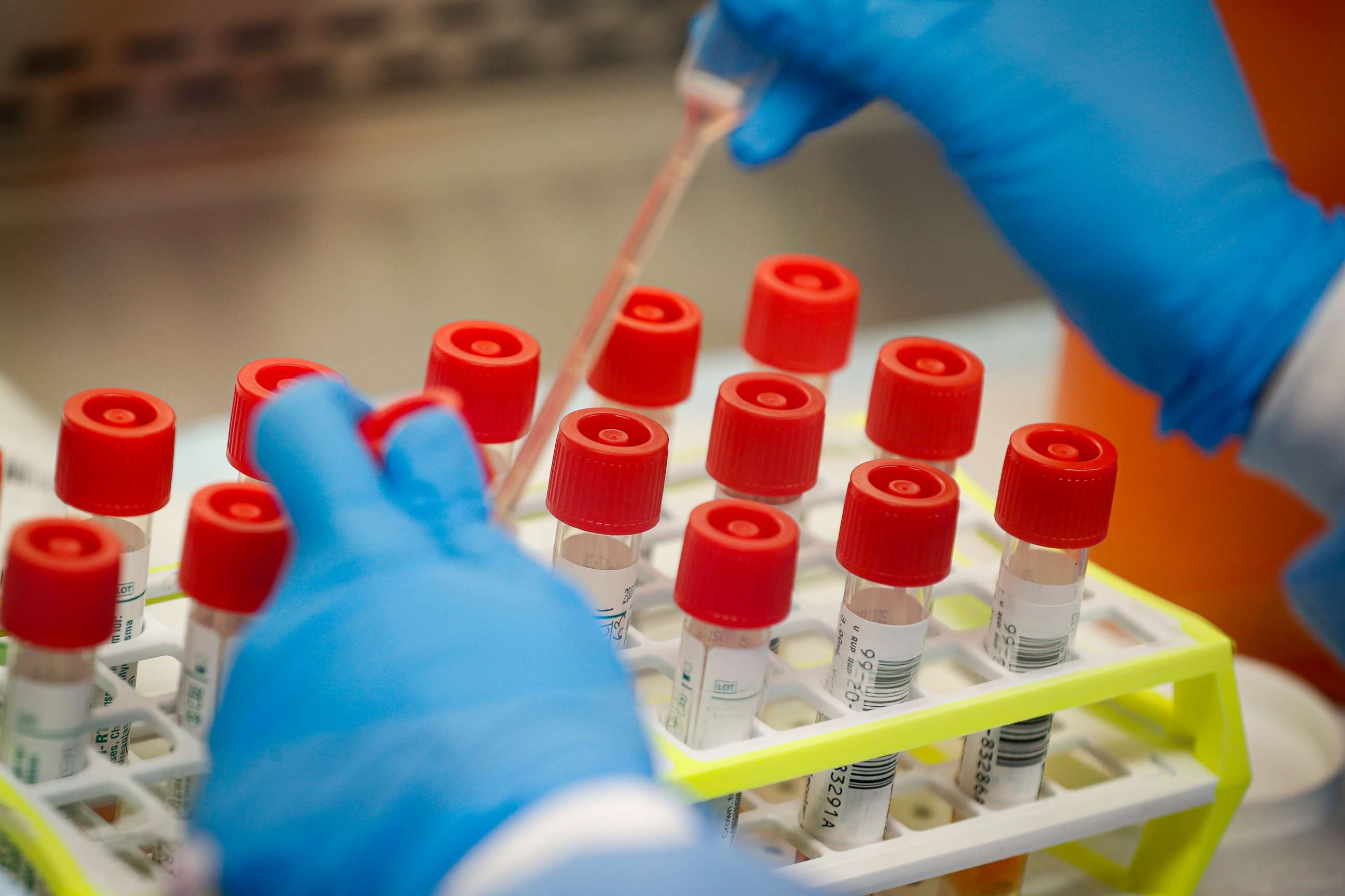 PHOTO: A technician prepares COVID-19 coronavirus patient samples for testing at a laboratory in Long Island, New York, March 11, 2020.