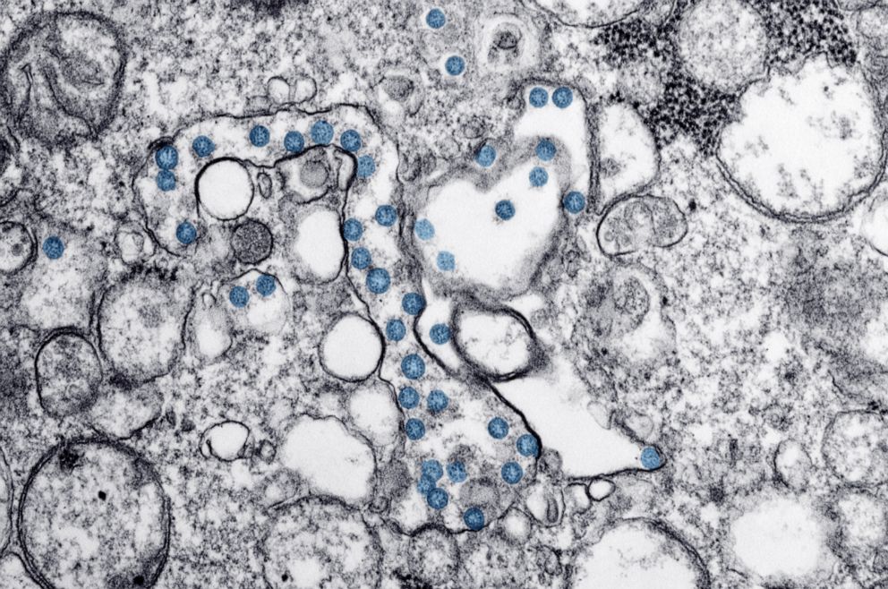 PHOTO: A transmission electron microscopic image of an isolate from the first U.S. case of COVID-19 was released by the CDC. The spherical viral particles, colorized blue, contain cross-section through the viral genome, seen as black dots.