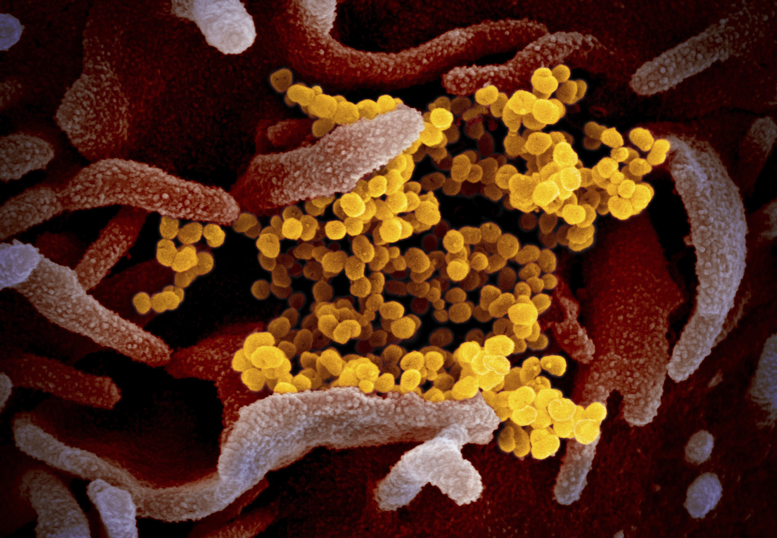 PHOTO: An electron microscope image made available by the U.S. National Institutes of Health in February 2020 shows the novel coronavirus SARS-CoV-2, yellow, emerging from the surface of cells, pink, cultured in the lab. The virus causes COVID-19.