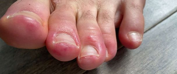 COVID Toes': Could skin conditions offer coronavirus clues? - ABC News
