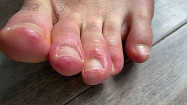 heel skin problems