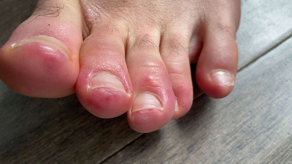 Unusual Skin Symptoms of Coronavirus: COVID Toes, Blisters