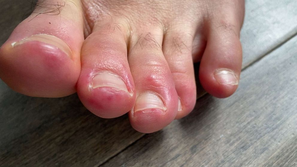 COVID Toes': Could skin conditions offer coronavirus clues? - ABC News