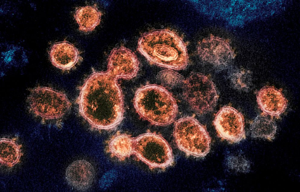 PHOTO: This 2020 electron microscope image provided by the National Institute of Allergy and Infectious Diseases shows SARS-CoV-2 virus particles, which cause COVID-19, isolated from a patient in the U.S., emerging from the surface of cells.