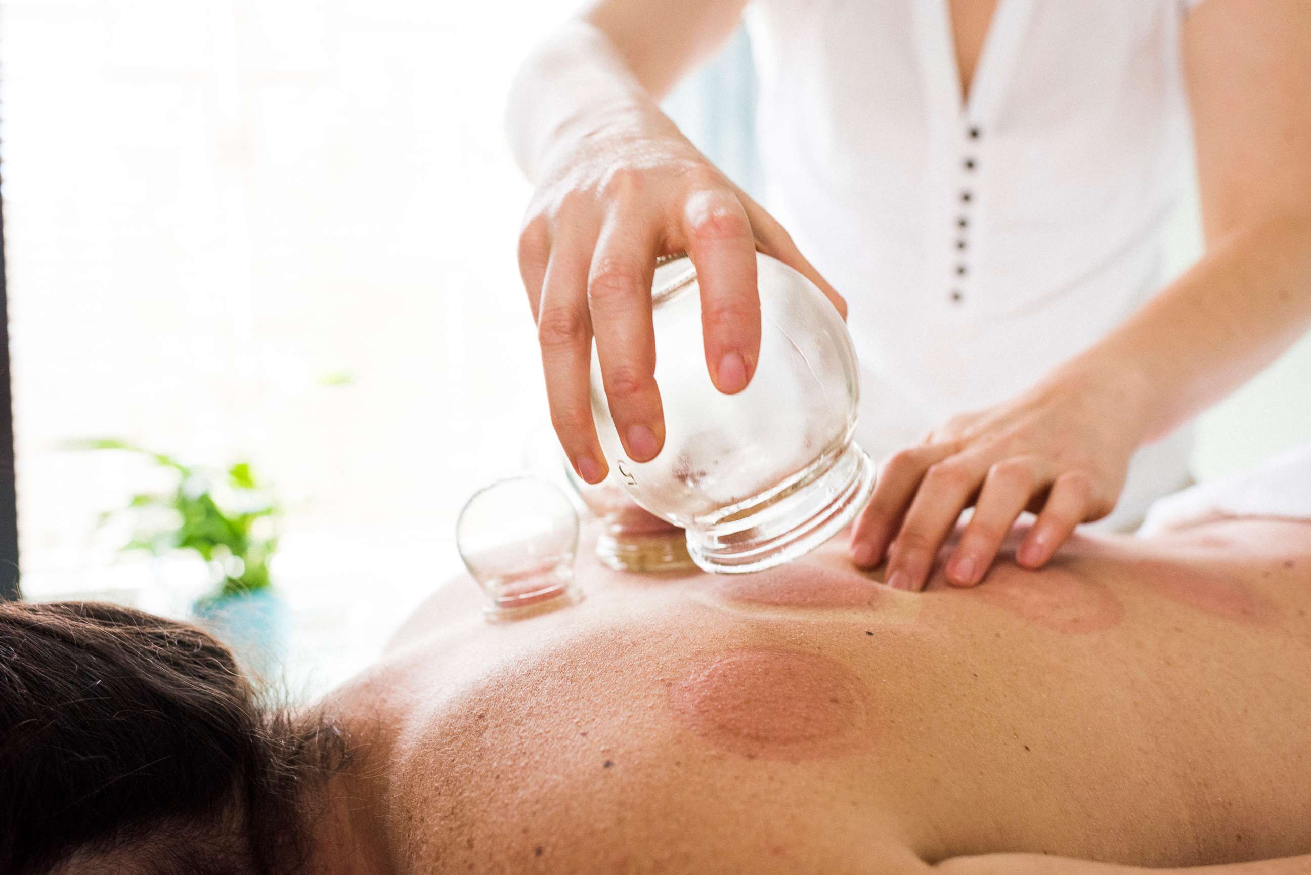 PHOTO: Photo of woman removing acupuncture cups from woman's back. Alternative Medicine. Cupping