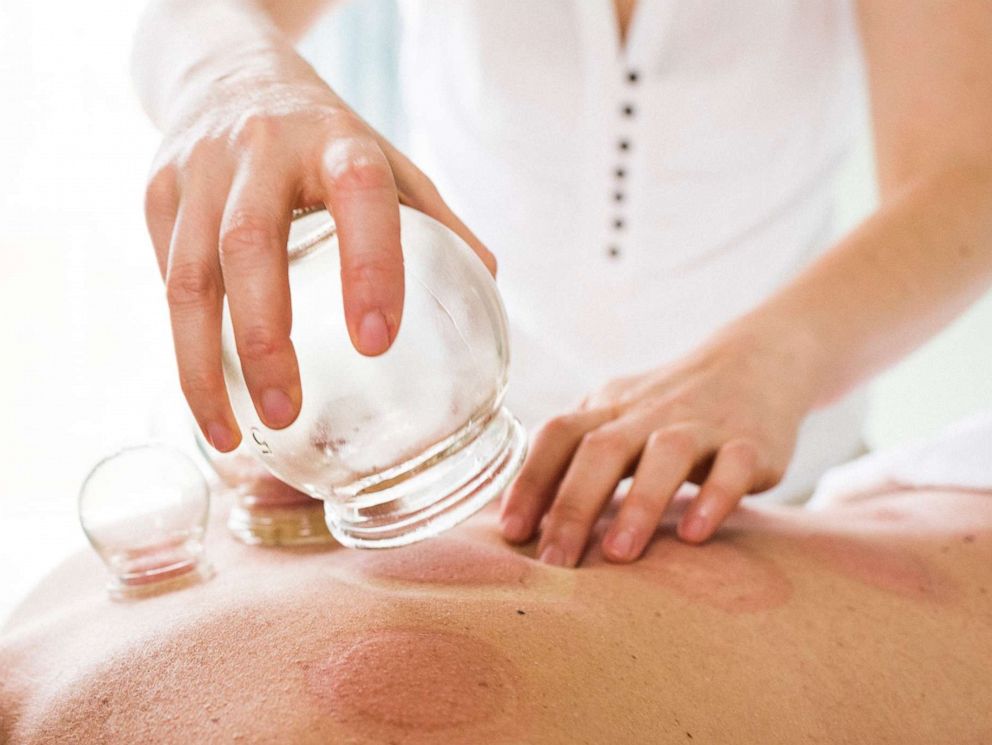 What Does Cupping Do In Chinese Medicine Medicinewalls