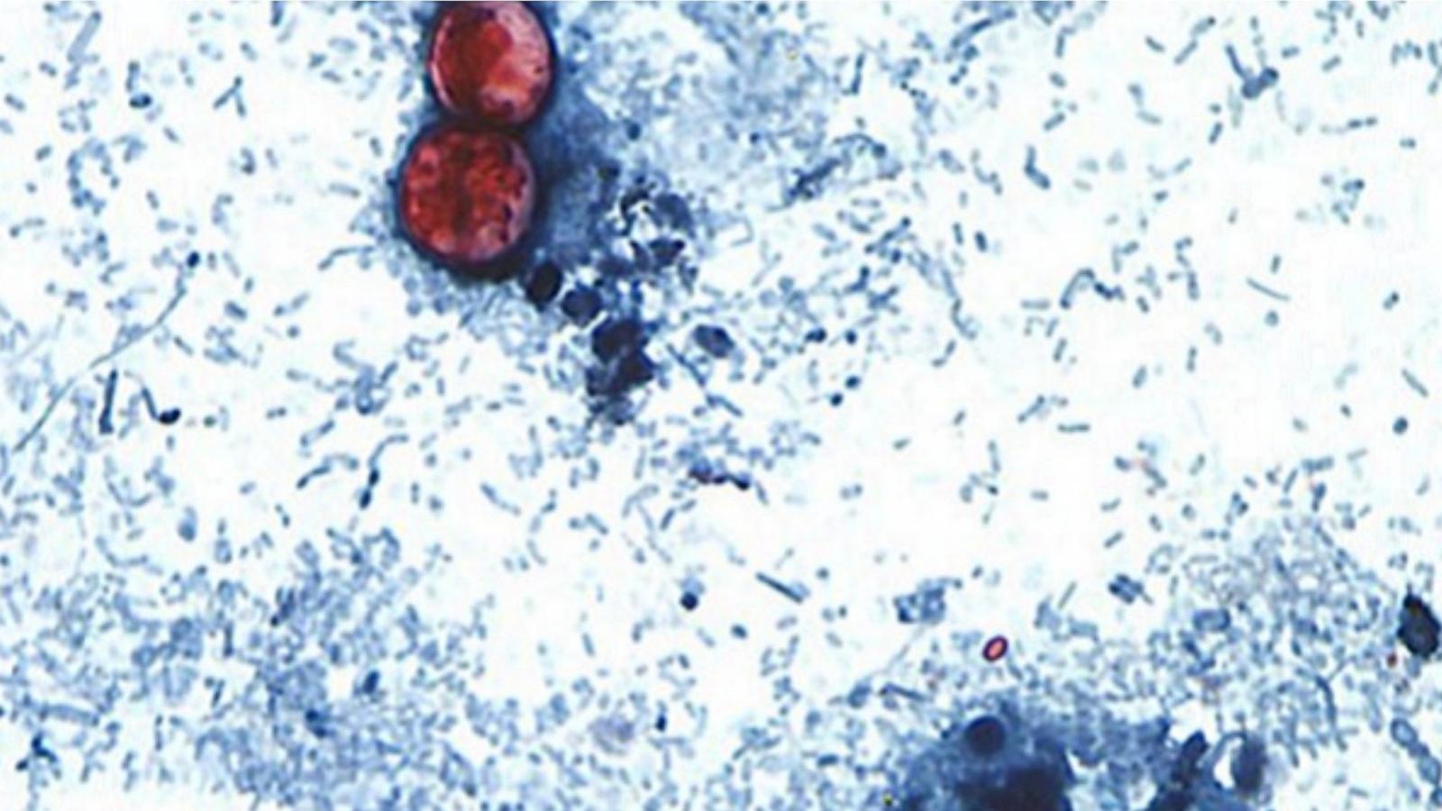 More than 24,000 cyclosporiasis infections reported as new cases appear to slow: CDC