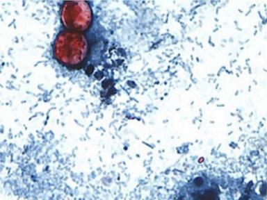 More than 24,000 cyclosporiasis infections reported as new cases appear to slow: CDC