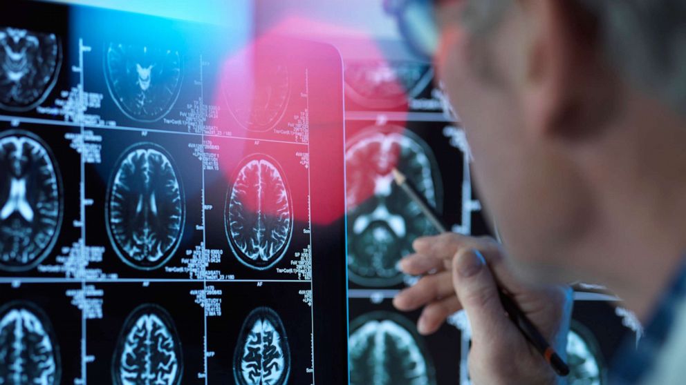 PHOTO: A doctor examines brain scans in an undated stock image.