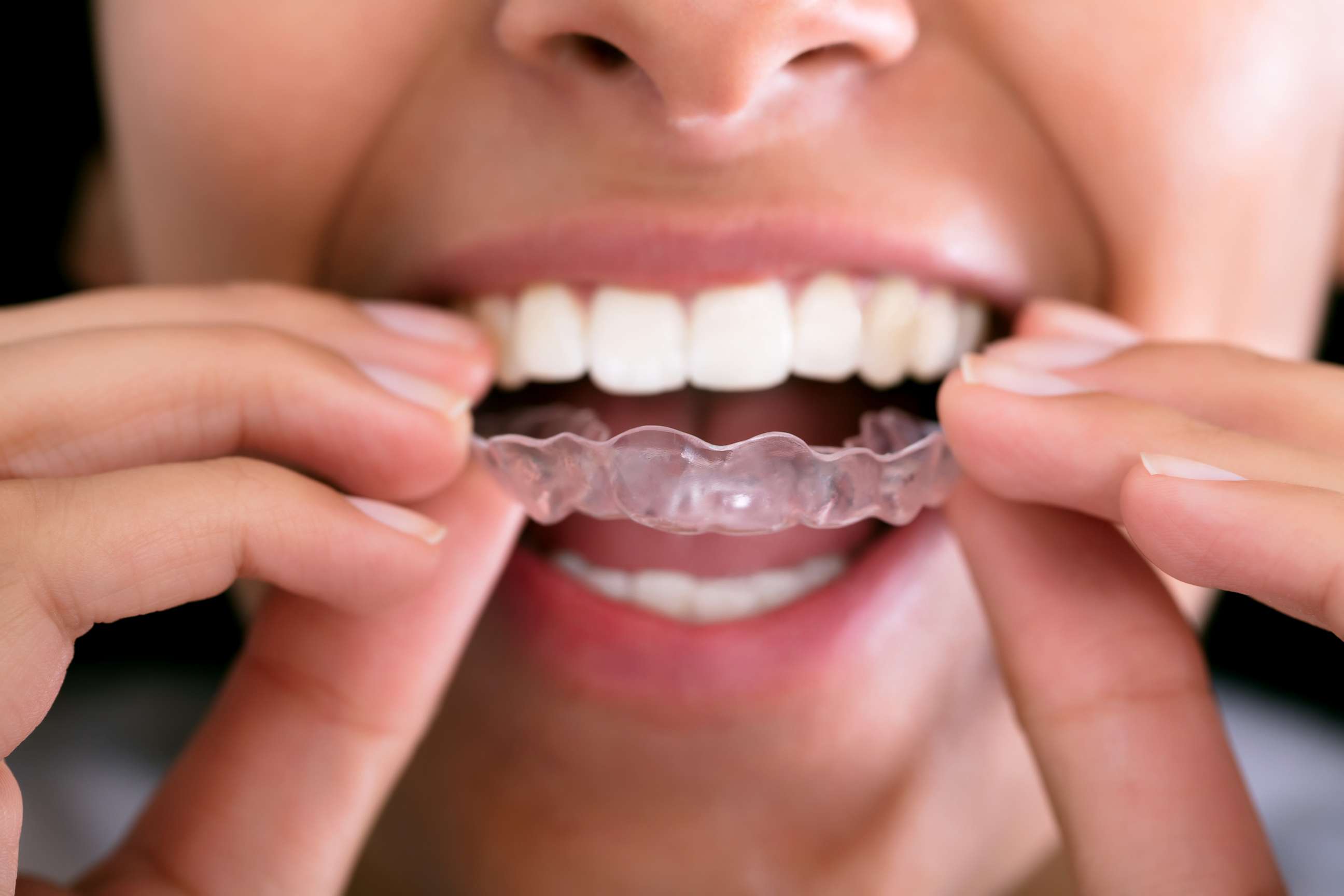 PHOTO: A woman inserts a mouth guard in this stock photo.