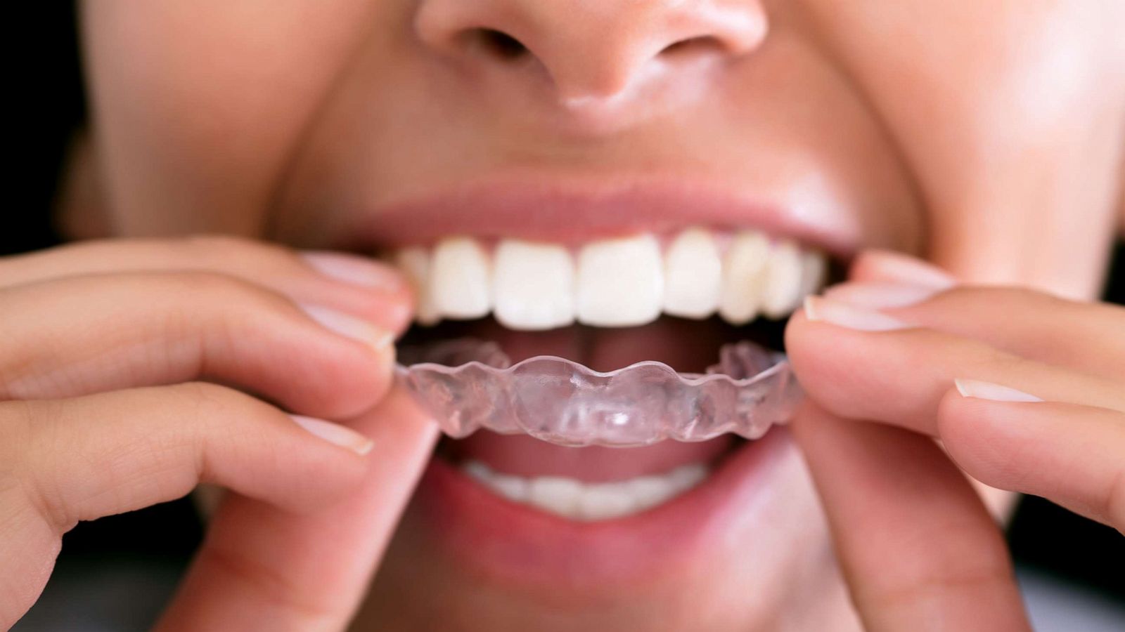 Brand New Sleeping Grinding Teeth Night Mouth Guard Gum Guard Bruxism Dental 