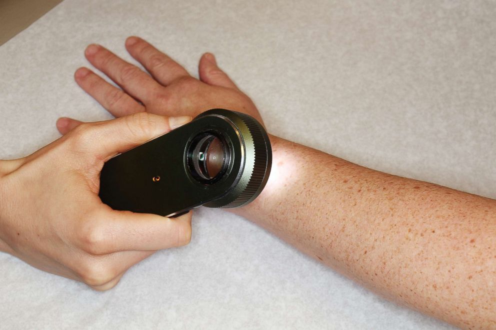 PHOTO: A dermatologist examining a skin lesion on the wrist with a dermatoscope. 